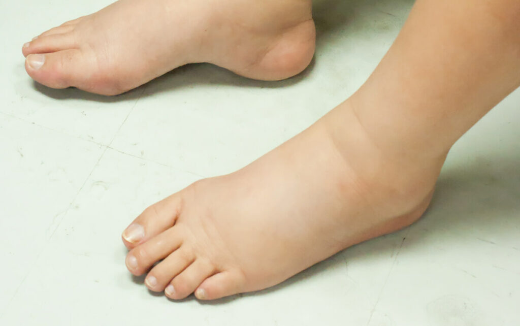 Obesity And Lymphedema 