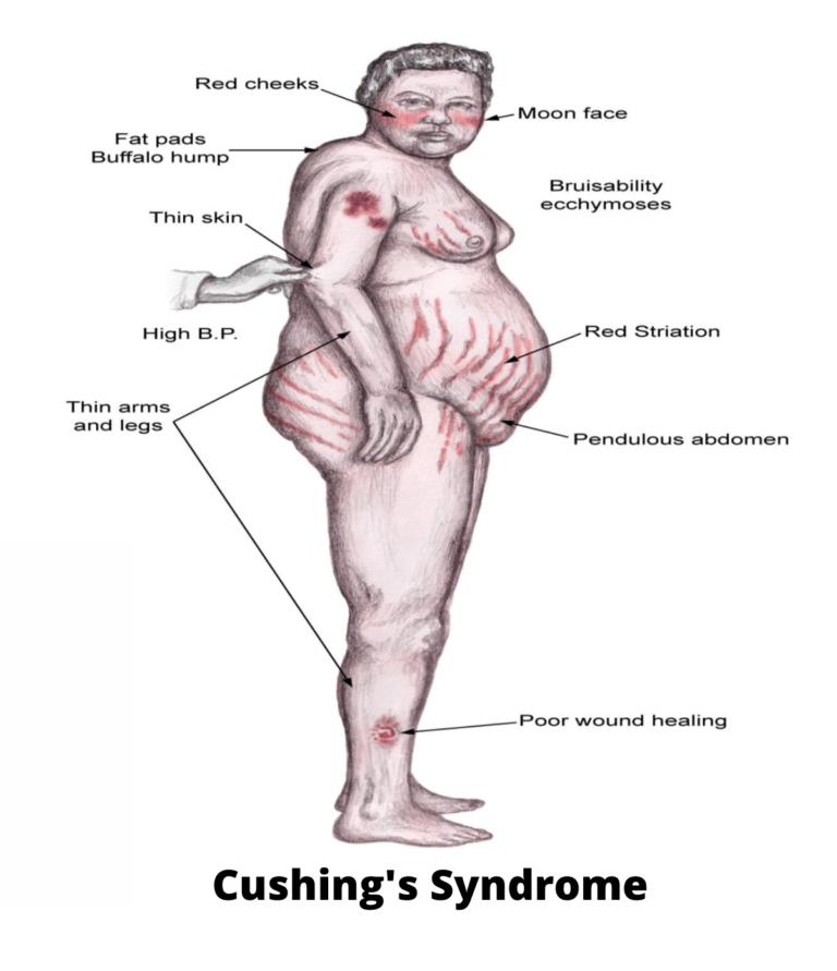 Cushing's Syndrome Diet | What Can I Eat To Reduce?