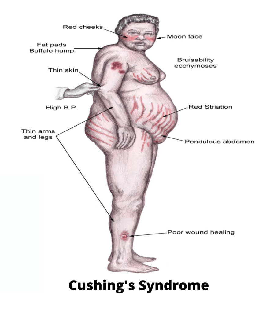 Symptoms Of Cushing's Syndrome
