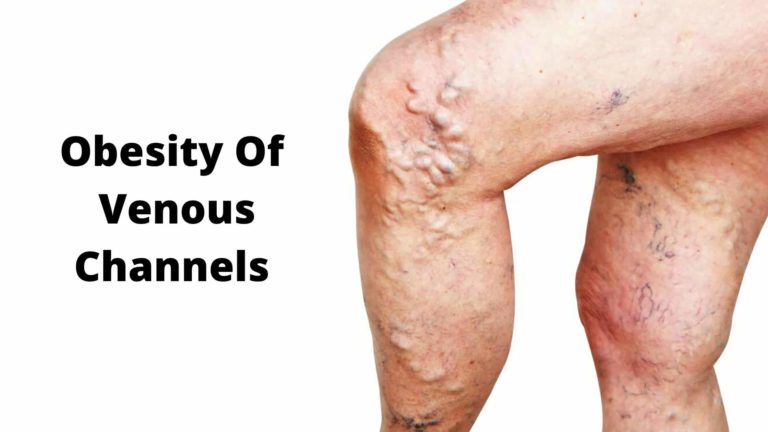 Obesity Of Venous Channels- Causes, Symptoms, And Treatments
