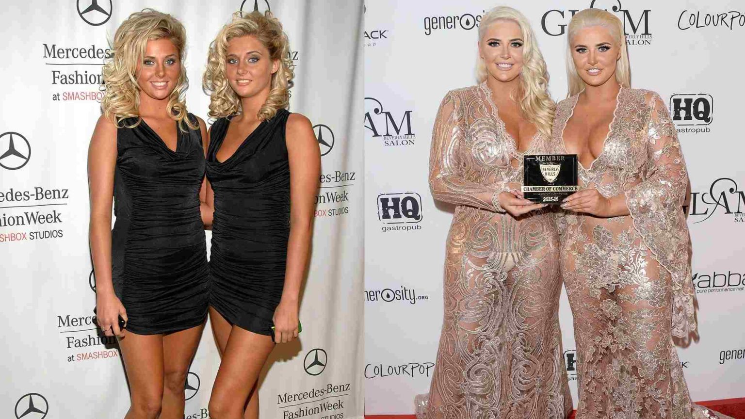 Shannon Twins Weight Gain How Did Their Plastic Surgery Went Wrong?