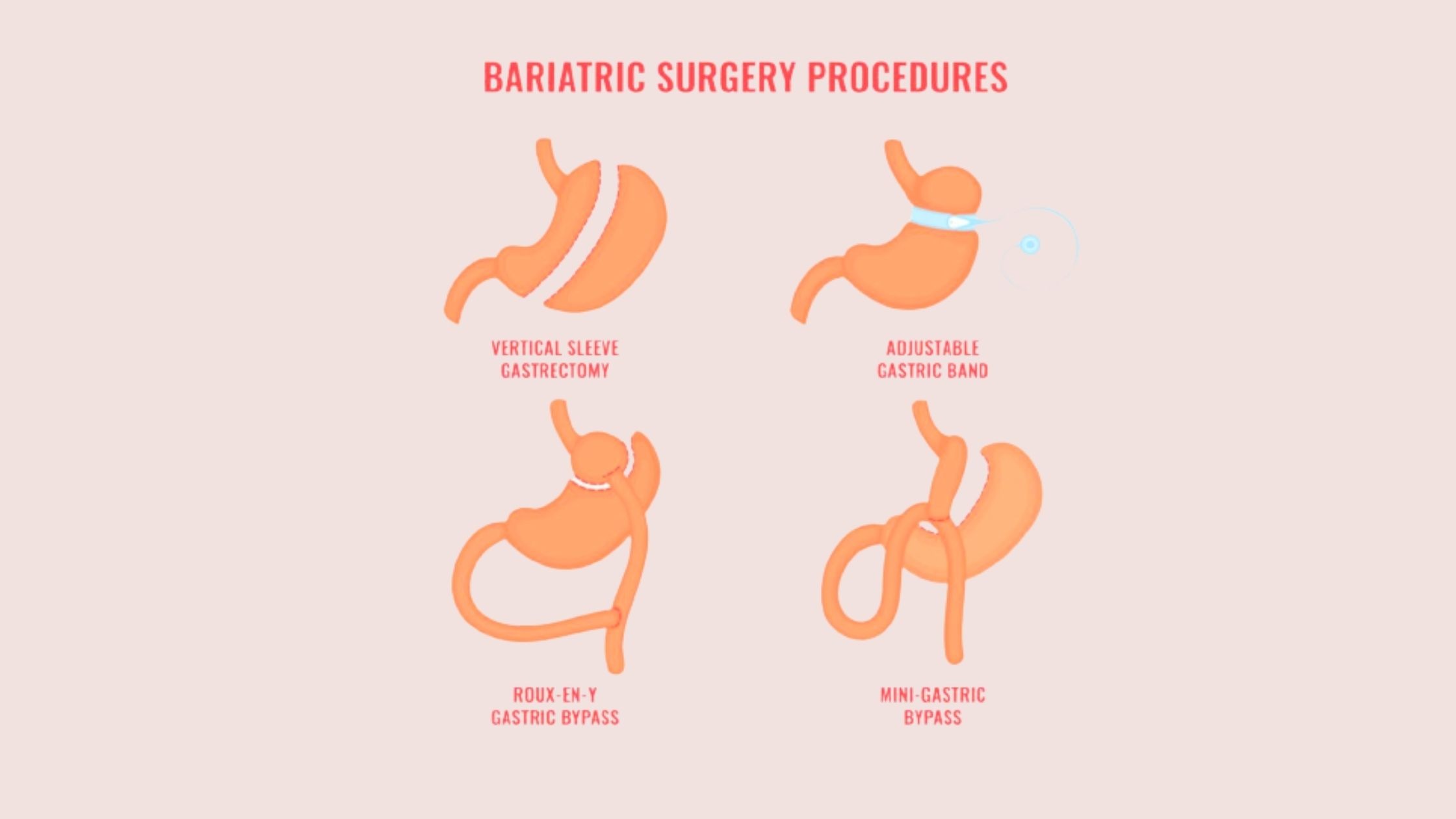 Bariatric Surgery Procedures