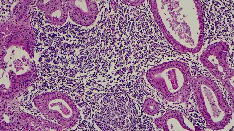Salivary Gland Cancer May Be Treated With P53 Gene – Researchers Found