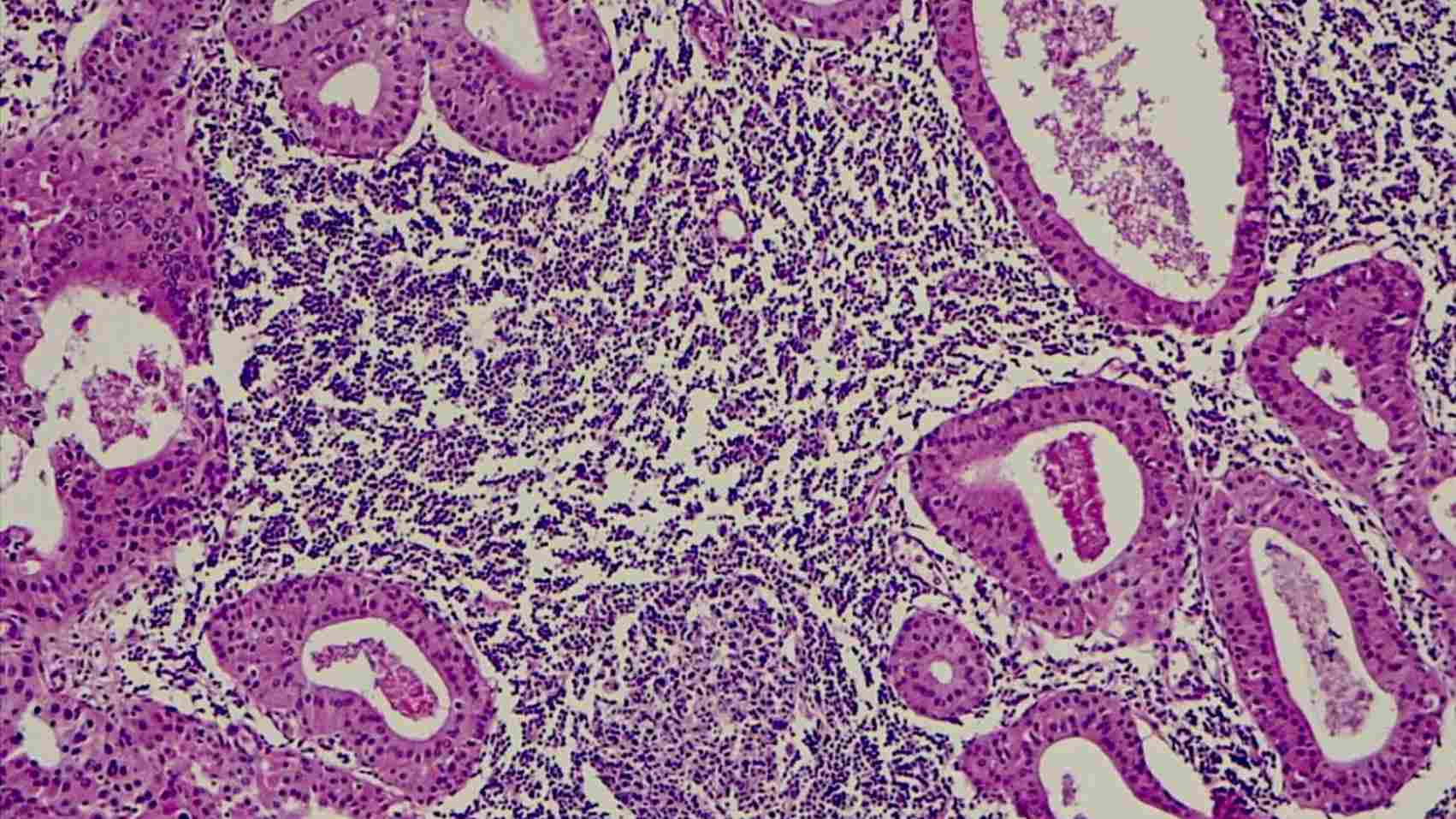 Salivary Gland Cancer May Be Treated With P53