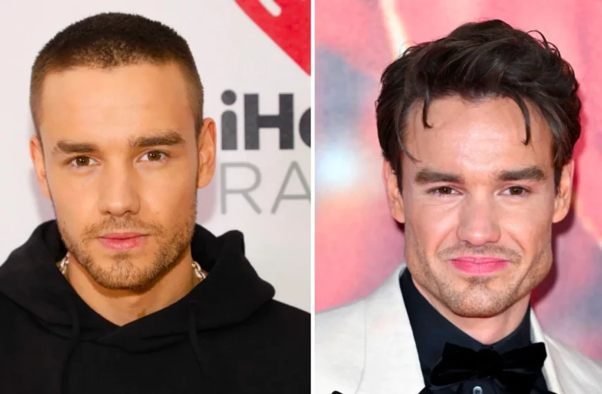 Liam Payne Buccal Fat Removal