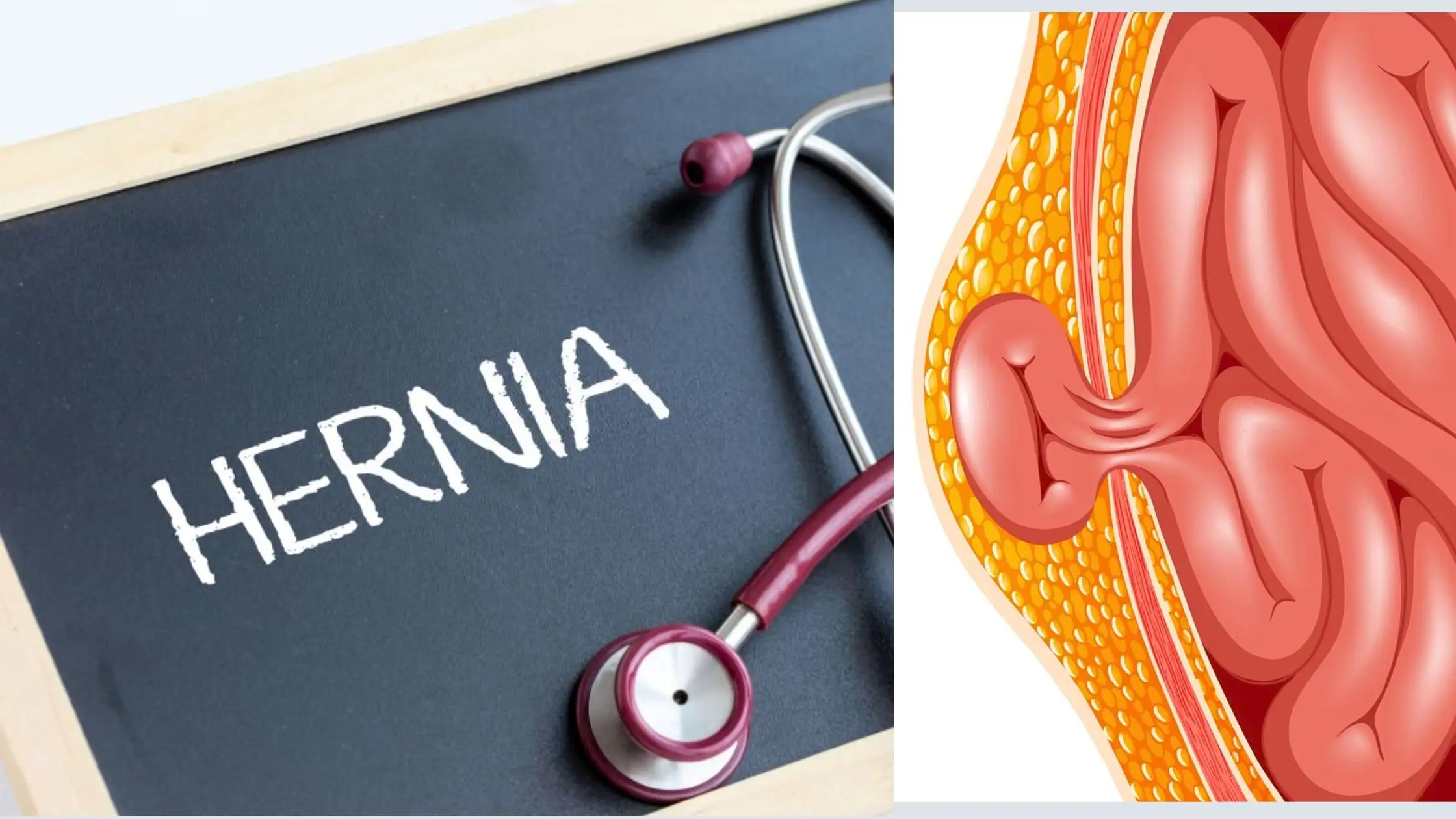 Hernia