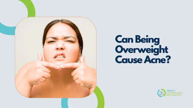 Can Being Overweight Cause Acne? Link Between Obesity and Skin Health!