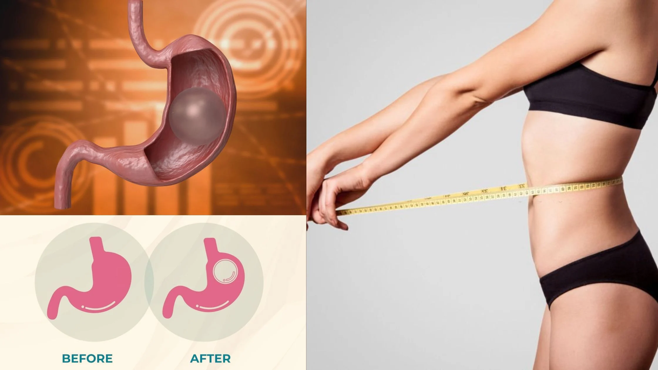 Gastric Balloon Aid In Weight Loss