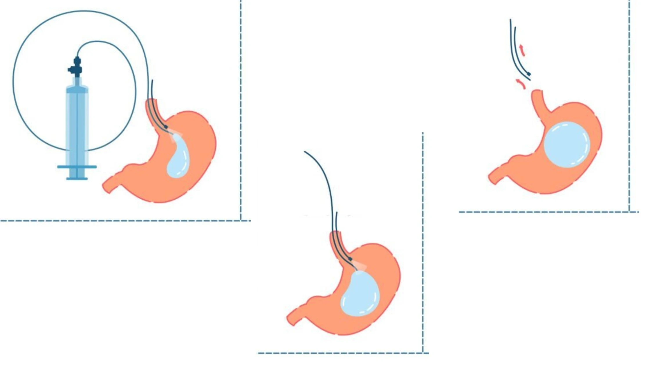 Gastric Balloon Process
