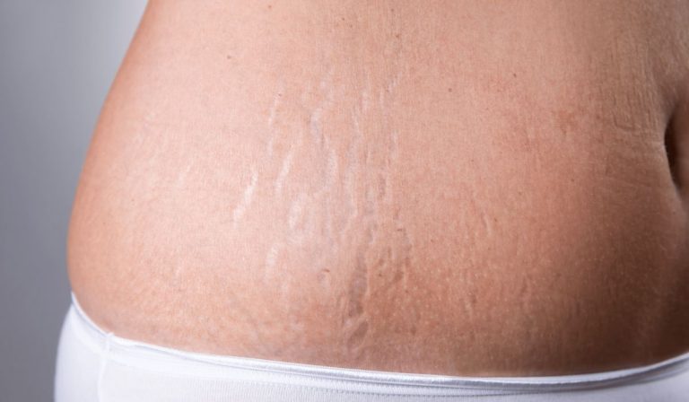 Microneedling for Stretch Marks: An Effective, Non-Invasive Solution